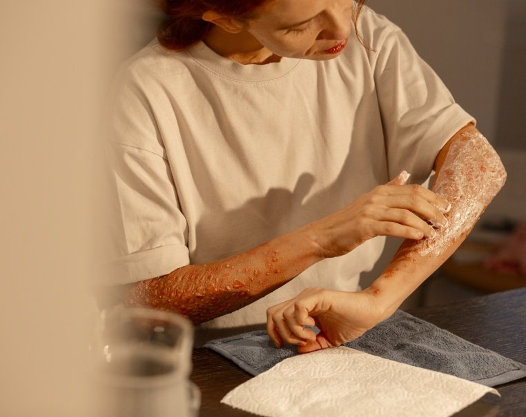 Ayurvedic Treatment For Psoriasis and Eczema