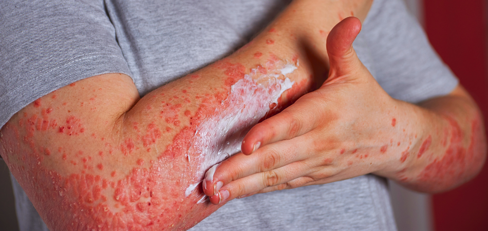 Ayurvedic Treatment for Skin Itching and Rashes