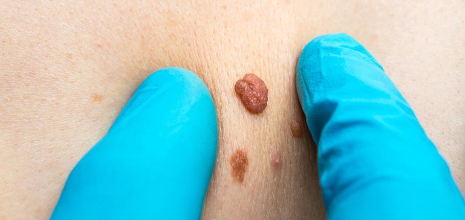 How to Remove Skin Tags at Home