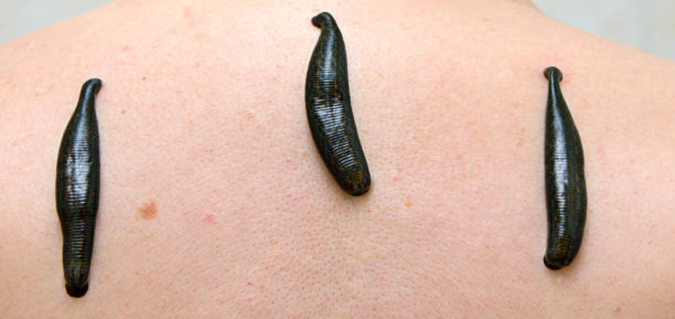 Benefits of The Ancient Leech Therapy
